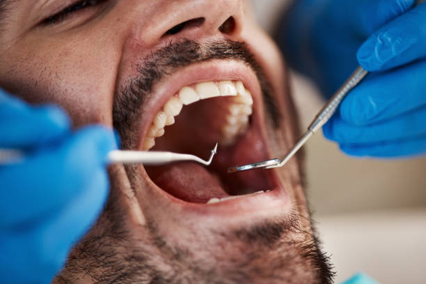 Best Emergency Wisdom Teeth Removal in Beach Haven West, NJ